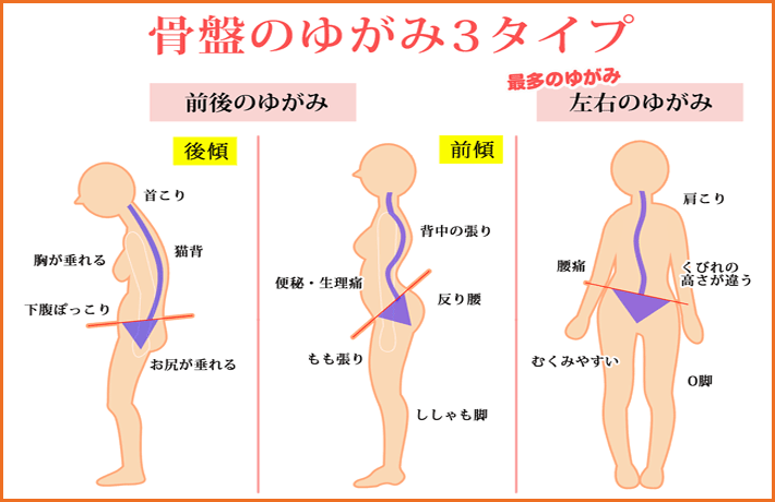 骨盤の歪み３タイプ①前傾②後傾③左右の傾き