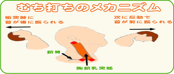 むち打ちのメカニズム